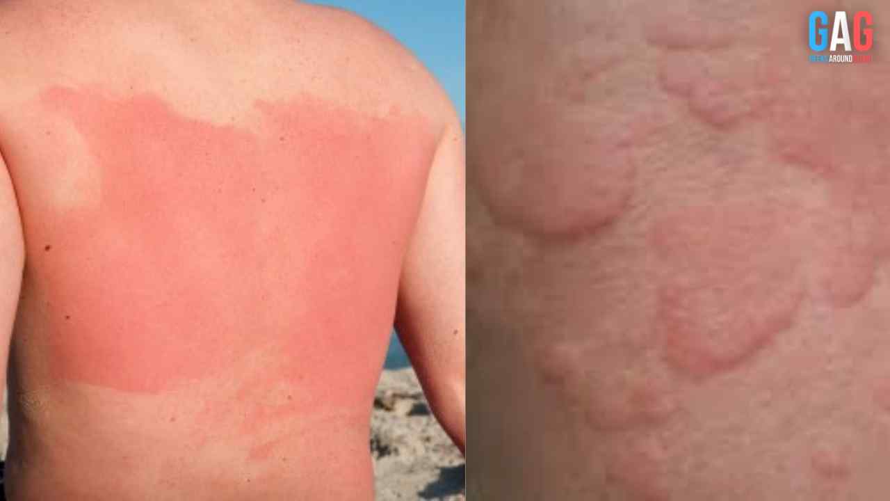 Heatstroke Rash What happens to a person when they are overexposed to heat?